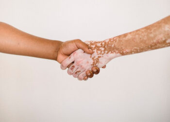 Vitiligo, a importância da conscientização e do cuidado integral