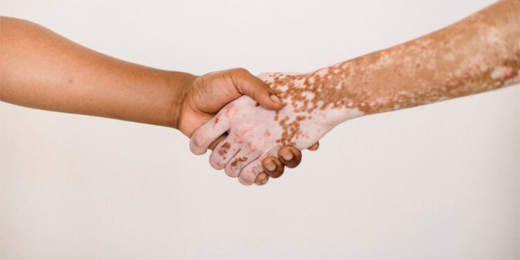 Vitiligo, a importância da conscientização e do cuidado integral